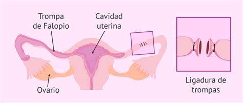 Es Posible Quedarse Embarazada Tras Una Ligadura De Trompas