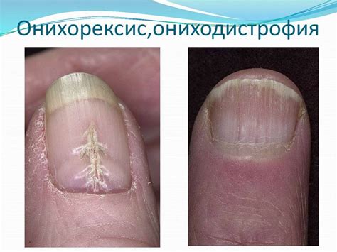 Виды грибковых заболеваний ногтей и их лечение