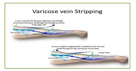 Great Saphenous Vein Varicose