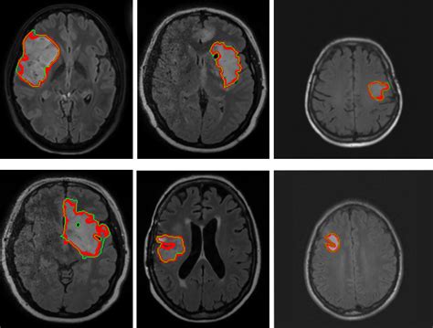 Segmentation Of Brain Tumors From MRI Using Adaptive Thresholding And