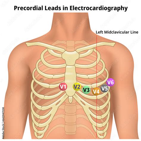 Precordial Leads in Electrocardiography - V1, V2, V3, V4, V5, and V6 ...