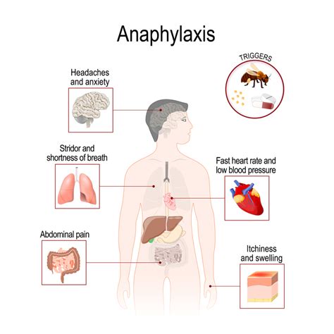 Anaphylaxis Pathway