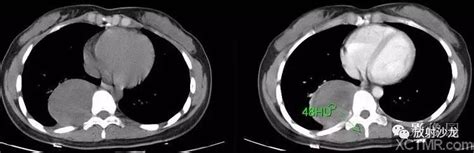 后纵隔神经纤维瘤mediastinal Neurofibromact病例 Medscicn