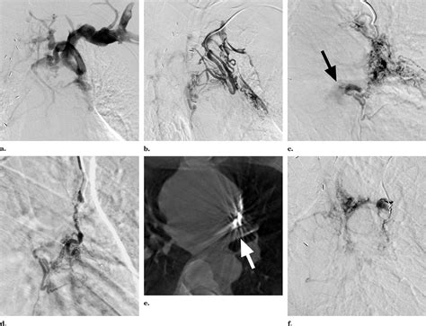 Figure 3 From Embolization Of A Symptomatic Systemic To Pulmonary