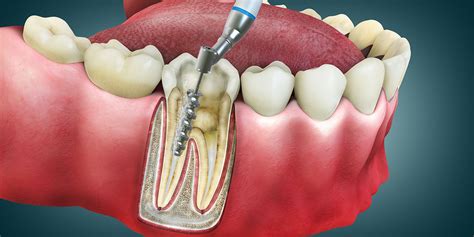 What Does A Root Canal Look Like Trafalgar Dental Oakville