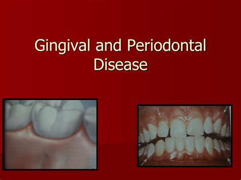 PPT Gingival And Periodontal Disease PowerPoint Presentation Free