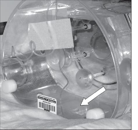 Figure 1 From Gas Bubble Motion Artifact In Mdct Semantic Scholar