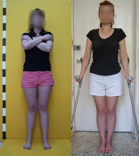 Operative Correction Of Bowed Legs Or Knock Knees Photos Of Patients