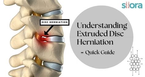 Understanding Extruded Disc Herniation — An Easy Guide - Siora ...