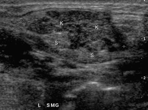 Figure 11 From Imaging The Major Salivary Glands Semantic Scholar