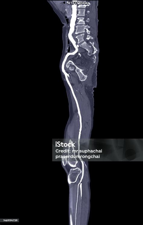 Cta Femoral Artery Run Off Mpr Curve Showing Right Femoral Artery For Diagnostic Acute Or