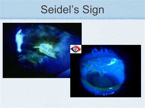 Ppt Postoperative Cataract Complications Powerpoint Presentation