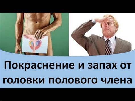 Покраснение и запах от головки полового члена - YouTube