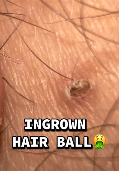 how to remove hair from scrotum