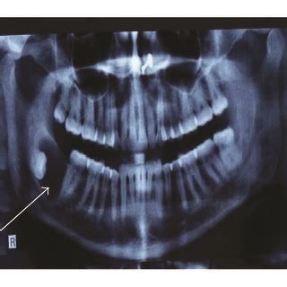 A An Opg Showing A Well Defined Radiolucency In Relation To Crown Of