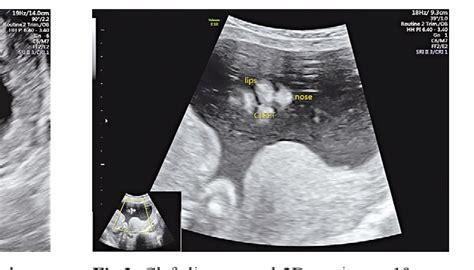 Figure 3 From Prenatal Diagnosis Of Cleft Lip And Cleft Lip Palate A