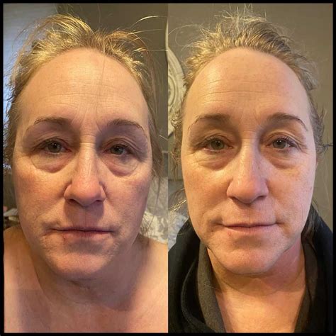 Cryotoning Before And After At Claudette Hudson Blog