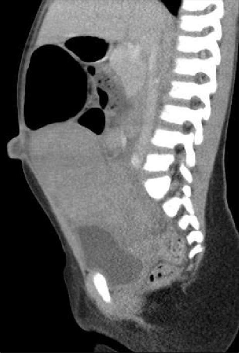 Computed Tomography Of The Abdomen Revealed A Cm Pelvic Soft Tissue