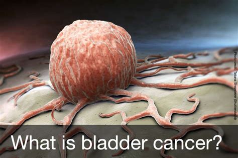 What Is Bladder Cancer Welcome To My Blog