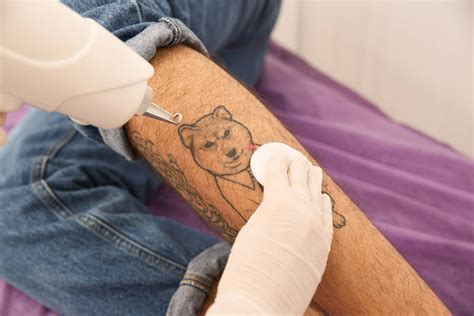 Eliminar Tatuajes En Alicante Sin Cicatriz