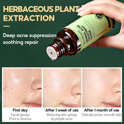 Vibrant Glamour Herbal Acne Treatment Set Tea Tree Oil Acne Serum Tone