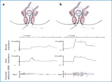 Biofeedback For Pelvic Floor Disorders | Viewfloor.co