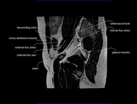 Mri Male Pelvis Anatomy Free Male Pelvis Sagittal Anatomy