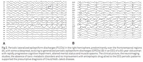 Scielo Brasil Periodic Eeg Patterns Importance Of Their Recognition