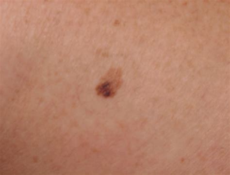 Melanoma Image 3b Large