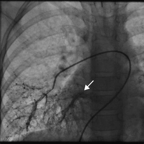 Pulmonary Angiogram Of Right Lower Lobe In Individual 2 The Angiogram Download Scientific