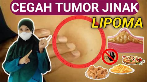 MENCEGAH MUNCULNYA LIPOMA DENGAN MENERAPKAN GAYA HIDUP SEHAT YouTube