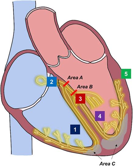 Frontiers Cardiac Resynchronization Considerations In Left Bundle