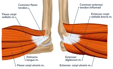 Lateral Tennis Medial Golfers Epicondylitis — Dr Jeevaka Jay