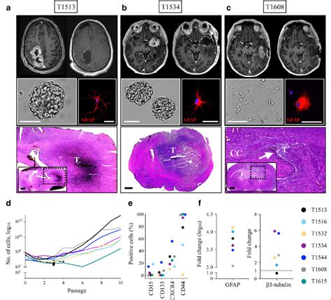 Characterization Of Glioblastoma Stem Cells From Recurrent GBM A C