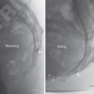 A To C A A Coronal Section Shows A Subseptate Uterus Day After