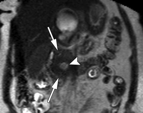 Mr Imaging Of Cystic Lesions Of The Pancreas Radiographics