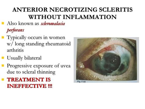 Uvea And Sclera