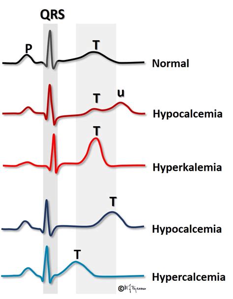 Hyperkalemia Ekg 11328 Hot Sex Picture