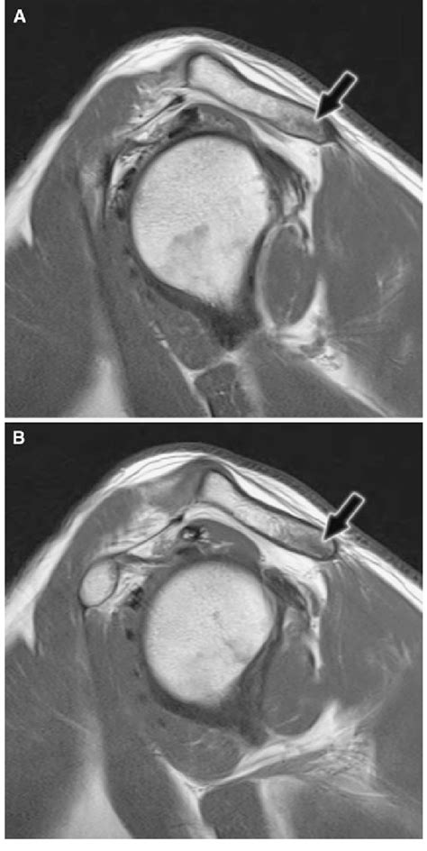 A And B Sagittal Pd Weighted Mr Images Show A Hypointense Thin Line At