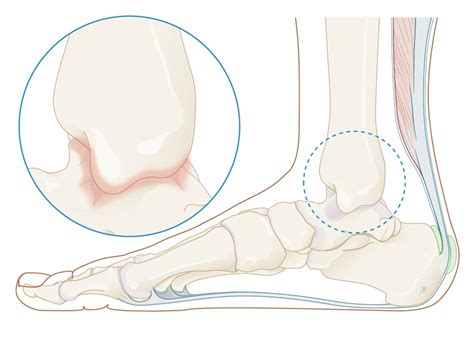 Voet en enkel: artrose van de enkel - Voetvak+ 