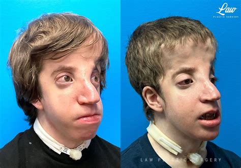 Craniofacial Reconstruction Before After Photos Law Plastic Surgery