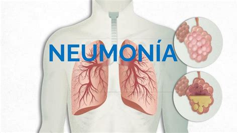 Neumonía en Pediatría medicina eli uDocz