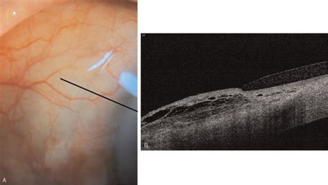 Recanalization Of XEN 45 Gel Stent Occlusion With Cortical Material