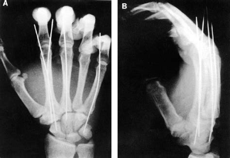 Herpetic Whitlow | Musculoskeletal Key