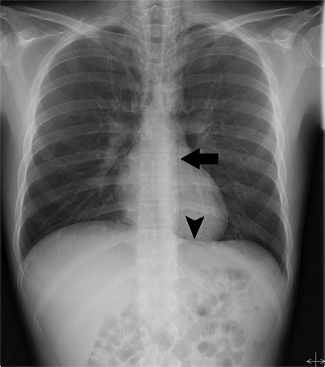 Spontaneous pneumomediastinum | BMJ Case Reports