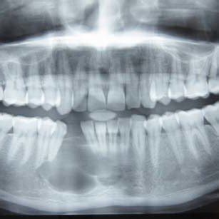 Opg Shows A Well Defined Unilocular Radiolucent Lesion In Right