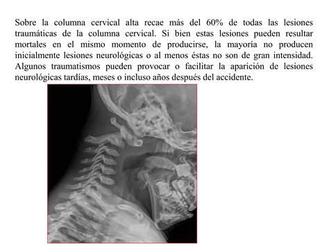 Lesiones Cervicales Sindrome De Latigazo Pdf