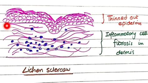 Lichen Sclerosus And Lichen Simplex Chronicus Pathology Youtube