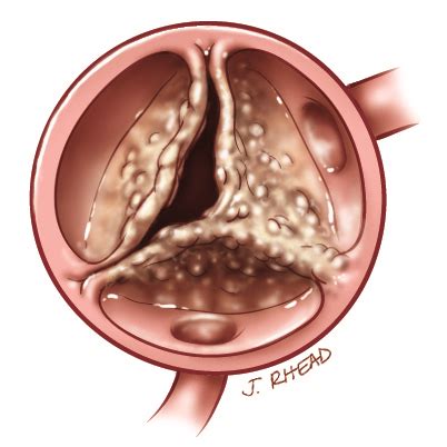 Bicuspid Aortic Valve | Heart Care | Intermountain Healthcare