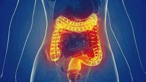 Diverticulitis Síntomas Tratamiento Y Prevención En Cuídateplus